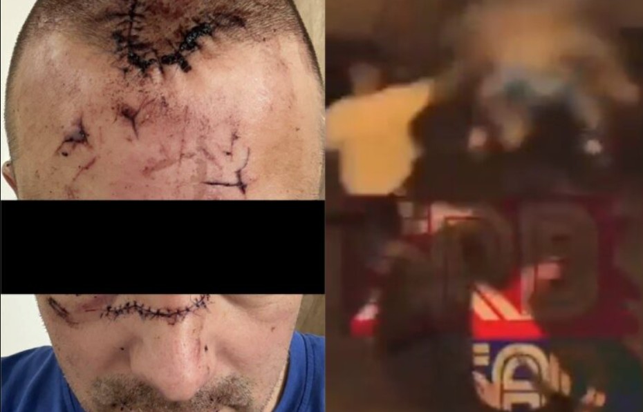 Objavljena fotografija čoveka kojeg je flašom udario Karlik Džons